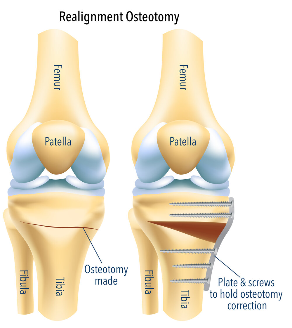 آرتروز زانو چیست؟ استئوتومی Osteotomy برای آرتروز زانو و یا پای پرانتزی